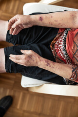 The image captures the hands of an elderly woman, showcasing distinctive marks and textures that tell a story of life and experience, symbolizing wisdom and the passage of time.