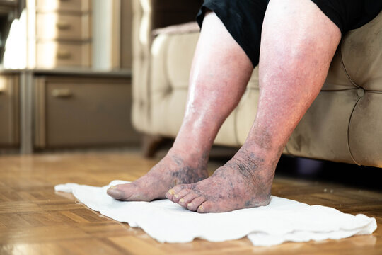 This image captures a close-up of swollen feet resting on a towel, emphasizing the texture and coloration that suggests a possible health issue or discomfort in the feet.
