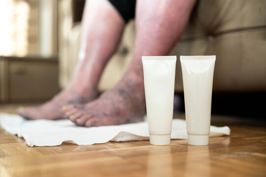 The image features feet resting on a towel beside two cream tubes, illustrating self-care routines and the importance of treating skin conditions in daily life for overall well-being.