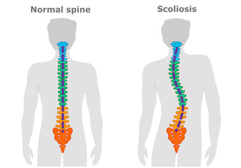  Scoliosis is a curvature of the spine. Vertebral column structure. Colored description. cervical spline, thoracic vertebrae, lumbar, pelvic, coccyx, spinal cord. Herniated disc. Vector illustration