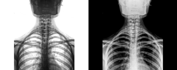 Neck Anterior View X-Ray Radiograph Showing Cervical Spine Alignment and Bone Structure for Diagnosis and Injury Evaluation Isolated on Transparent Background