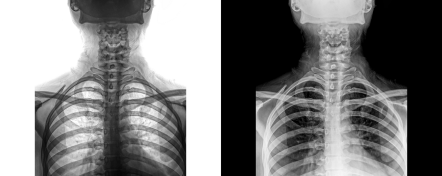 Cervical Spine Anterior View X-Ray Radiograph Illustrating Neck Bone Anatomy for Diagnosis and Traumatic Injuries Isolated on Transparent Background