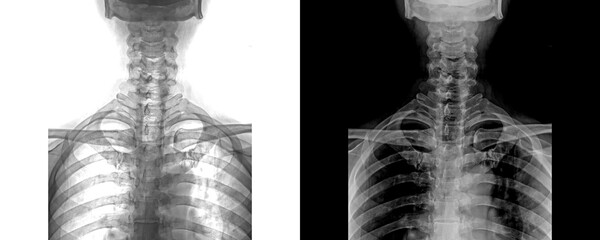 Neck Anterior View X-Ray Showing Vertebral Column for Identification and Structural Issues Isolated on Transparent Background