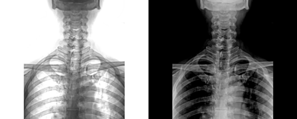 Neck Anterior View X-Ray Showing Vertebral Column for Identification and Structural Issues Isolated on Transparent Background