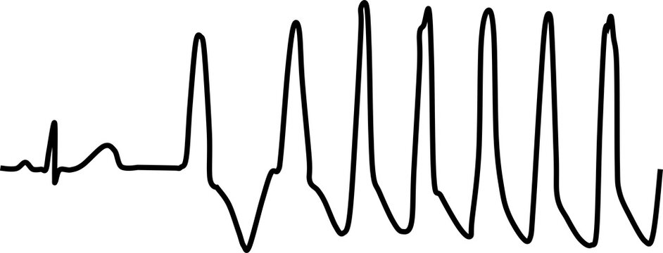 心室頻拍のグラフィック素材イラスト