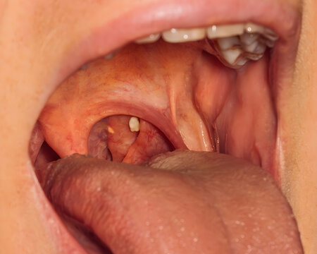 Detailed view of the anatomy of the oral cavity, tonsils with pus plugs, close-up