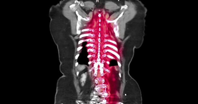 CTA whole aorta showing aortic aneurysm with contrast enhancement. High-quality radiologic image demonstrating vascular abnormality and advanced diagnostic imaging technology.