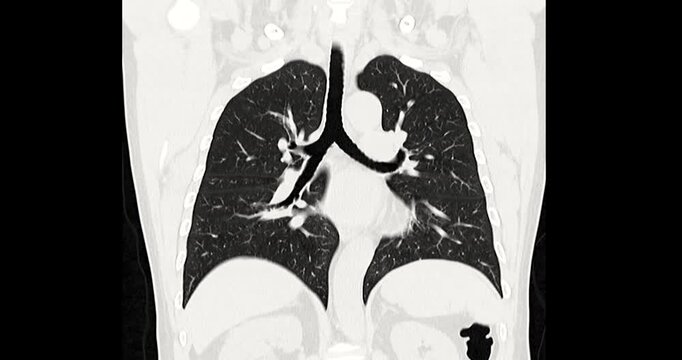 Footage of CT chest scan showing detailed lung and heart anatomy. Demonstrates advanced radiology technology for precise diagnosis and modern medical imaging innovation.
