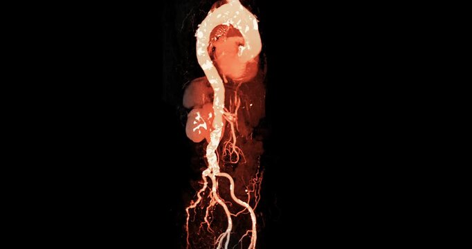 CTA whole aorta showing aortic aneurysm with contrast enhancement. High-quality radiologic image demonstrating vascular abnormality and advanced diagnostic imaging technology.