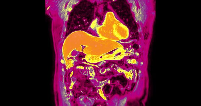 Colorful MRI upper abdomen showing vivid visualization of abdominal organs and vessels. Demonstrates advanced radiology imaging technology for precise medical diagnosis and research.