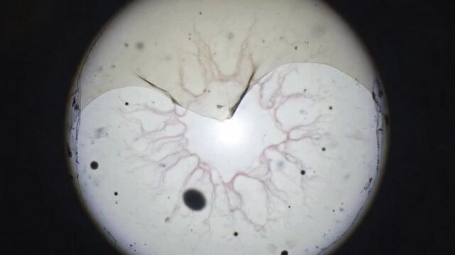 A 3D animation of a retinal detachment inside the human eye