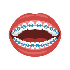 Open mouth with white teeth and blue orthodontic braces on a white background.