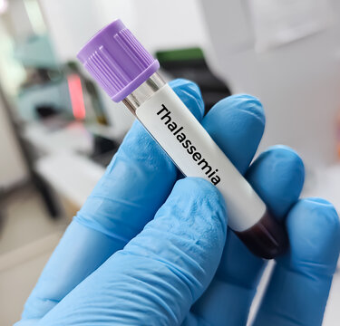 Blood sample for Electrophoresis test. Diagnosis of Thalassemia (alpha or beta).