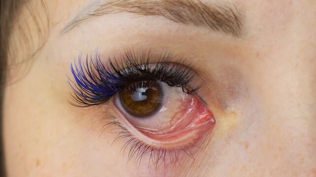 Chemical (Alkali and Acid) Injury of the Conjunctiva and Cornea. Eye Corneal Burn close up