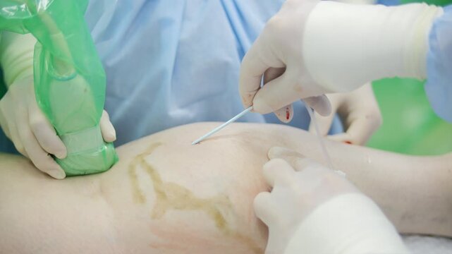 Endovenous laser ablation procedure on patient leg