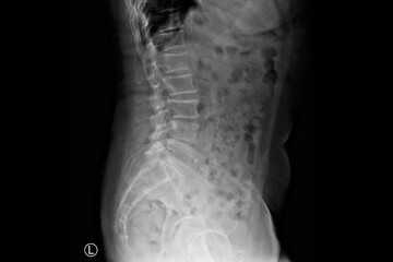 Lateral lumbar spine X-ray radiograph showing scoliosis with vertebral curvature, lower back...