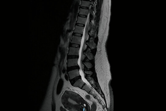 Sagittal lumbar spine MRI showing vertebrae, intervertebral discs, spinal canal, and spinal cord anatomy. Medical diagnostic imaging for disc herniation evaluation, spinal stenosis detection.