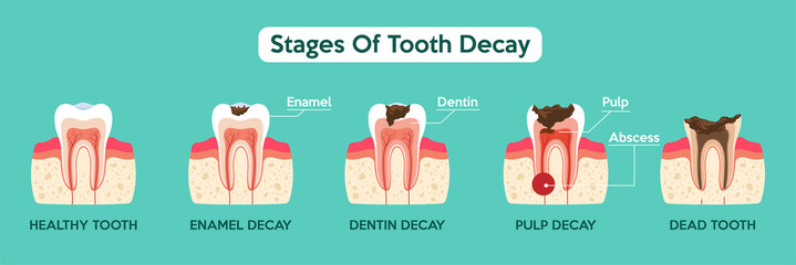 Stage Of Tooth Decay