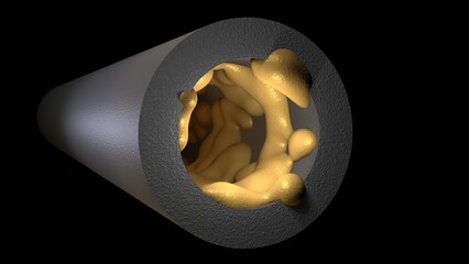 Biofilm accumulation inside tube. Clog in pipe. Atherosclerosis. Arterial blockage with plaque, cholesterol, debris buildup. 3d render illustration. 