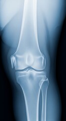 Knee X-Ray - Medical Imaging of Bone Structure and Joint Health.