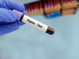 Doctor  holding a test blood sample for Sepsis- test. Laboratory medical testing concept.