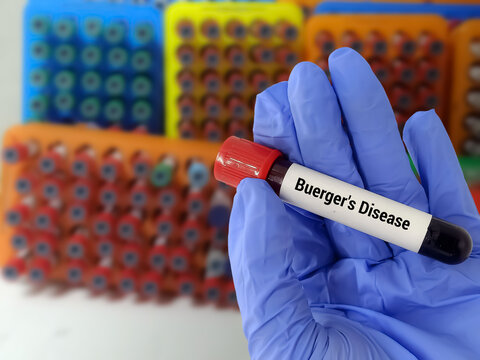Doctor  holding a test blood sample for Buerger's Disease - test. Laboratory medical testing concept.