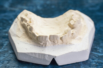 Dental plaster cast on a blue background in a dental laboratory