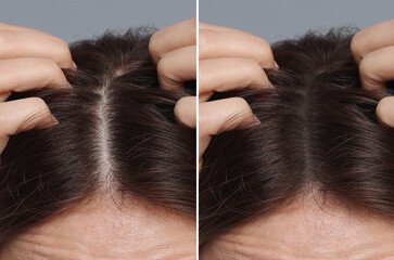 Obraz premium Woman with hair loss problem before and after therapy, closeup. Collage on grey background
