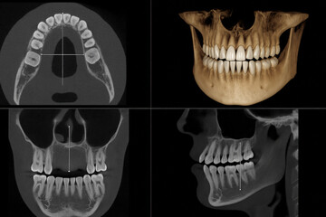 Detailed dental CT scan showing axial, coronal, sagittal, and 3D views of jaw and teeth for diagnostic and treatment plan