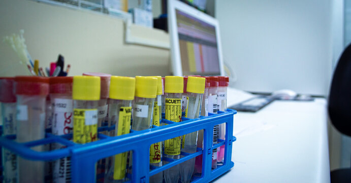 Tubos de ensayo con tap&oacute;n amarillo y etiquetas de muestra en gradilla de laboratorio cl&iacute;nico, listos para an&aacute;lisis de sangre, con pantalla de resultados de paciente en el fondo.