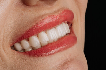 Closeup smile with white porcelain veneers and coral lipstick dental aesthetic beauty