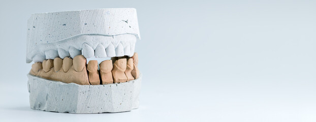 Dental stone model for crown fitting procedure