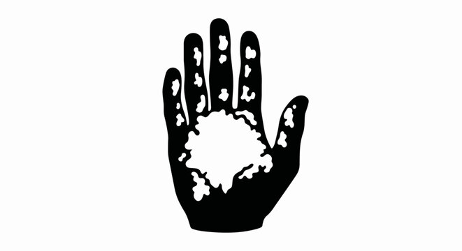 Vitiligo skin condition icon. Black and white vector illustration of a hand with depigmentation. Dermatology and skin diversity symbol