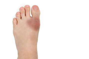 Blue bruise on the foot on a white background.