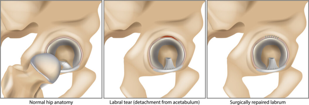 Detailed medical illustration showing the stages of hip labral injury and repair. Labrum reattached to acetabulum, Surgically repaired labrum, Labral tear