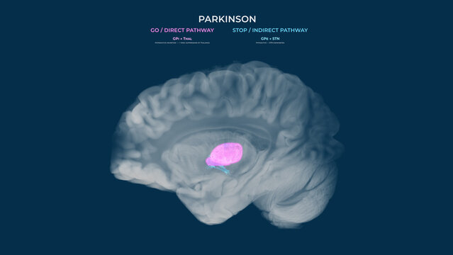 Parkinson Dopamine Loss Basal Ganglia Pathway Imbalance Sagittal View