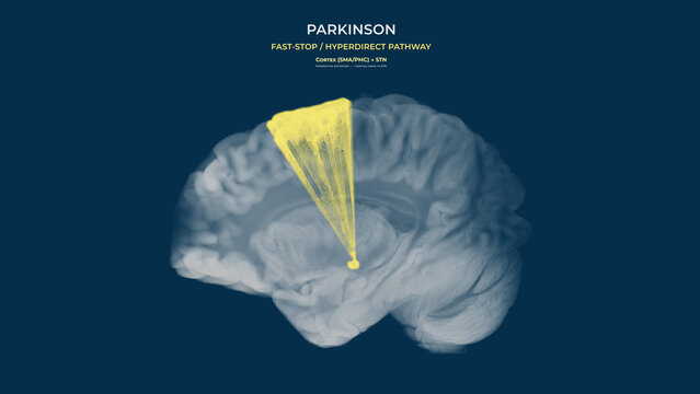 Parkinson Dopamine Loss Hyperdirect Pathway Overactivation Sagittal View