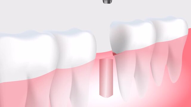 filling of new teeth
