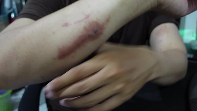 A man who feels angry because of itchy skin which causes red irritation on his hands