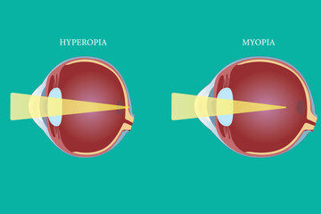 Medical illustration comparing hyperopia and myopia focusing differences in the human eye. eps 10