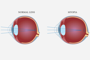 Medical illustration comparing normal vision and myopia focus in the human eye. eps 10
