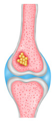 Bone Cancer Cross Section illustration