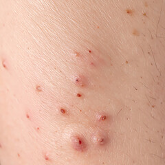 Close up of human skin with visible blemishes pimples and imperfections