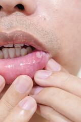 Mouth Ulcer Sore or Aphthous Stomatitis. Oral Health and Medical concepts
