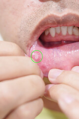 Mouth Ulcer Sore or Aphthous Stomatitis. Oral Health and Medical concepts
