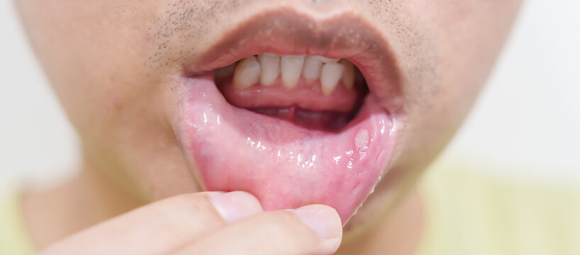 Mouth Ulcer Sore or Aphthous Stomatitis. Oral Health and Medical concepts