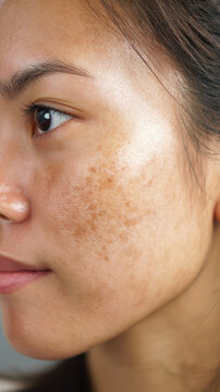 Close-up of a woman's face highlighting skin texture, freckles, and pigmentation with natural lighting and neutral background