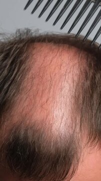 Close-up of male head with thinning hair and baldness while combing, showing receding hairline and hair loss problem. Vertical video.