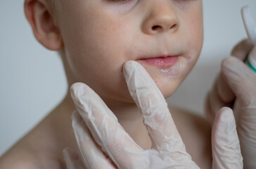 Hands with gloves putting cream on boys face with red rash infection around his mouth, blurred...