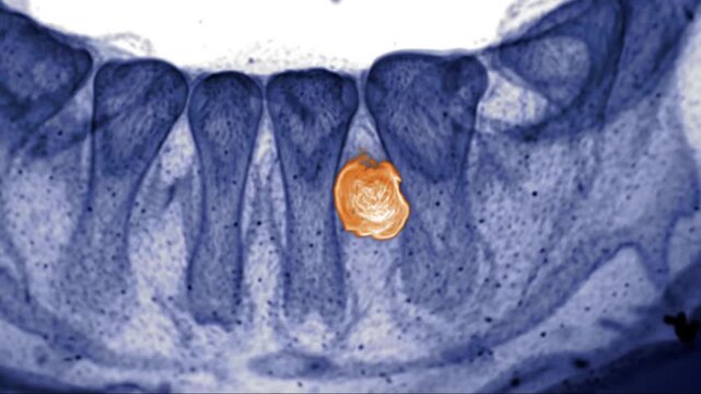 Dental XRay Scan Showing Impacted Tooth Medical Visualization of Jaw and Teeth